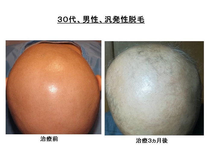 円形脱毛症　病院""